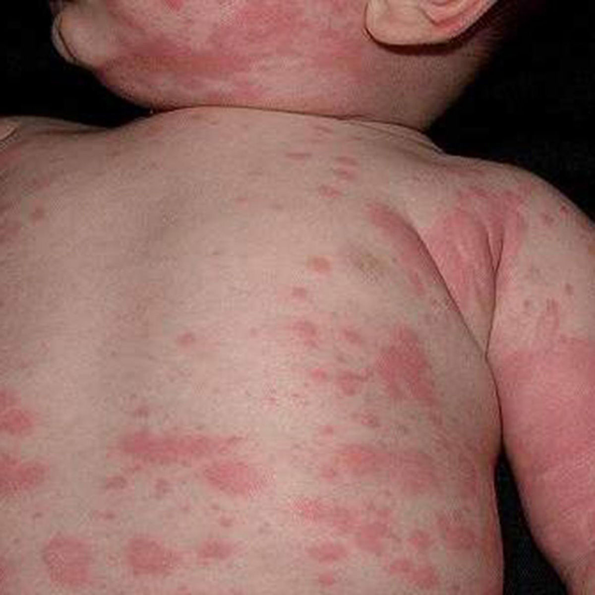 https://www.kidsallergy.co.za/wp-content/uploads/2022/01/12-urticaria.jpg
