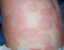 https://www.kidsallergy.co.za/wp-content/uploads/2022/01/urticaria-1.jpg